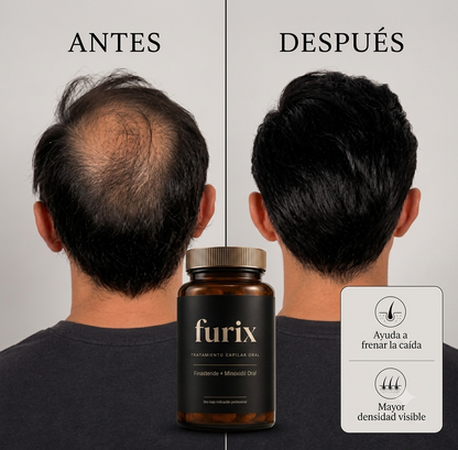 Furix | Finasteride + Minoxidil para la caída capilar